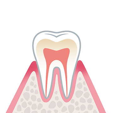 症状1（歯肉炎）