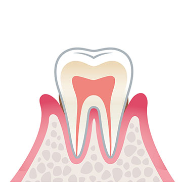 症状2（軽度歯周病）