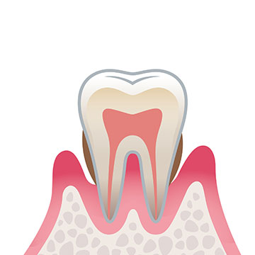 症状3（中度歯周病）