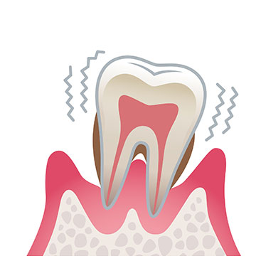 症状4（重度歯周病）